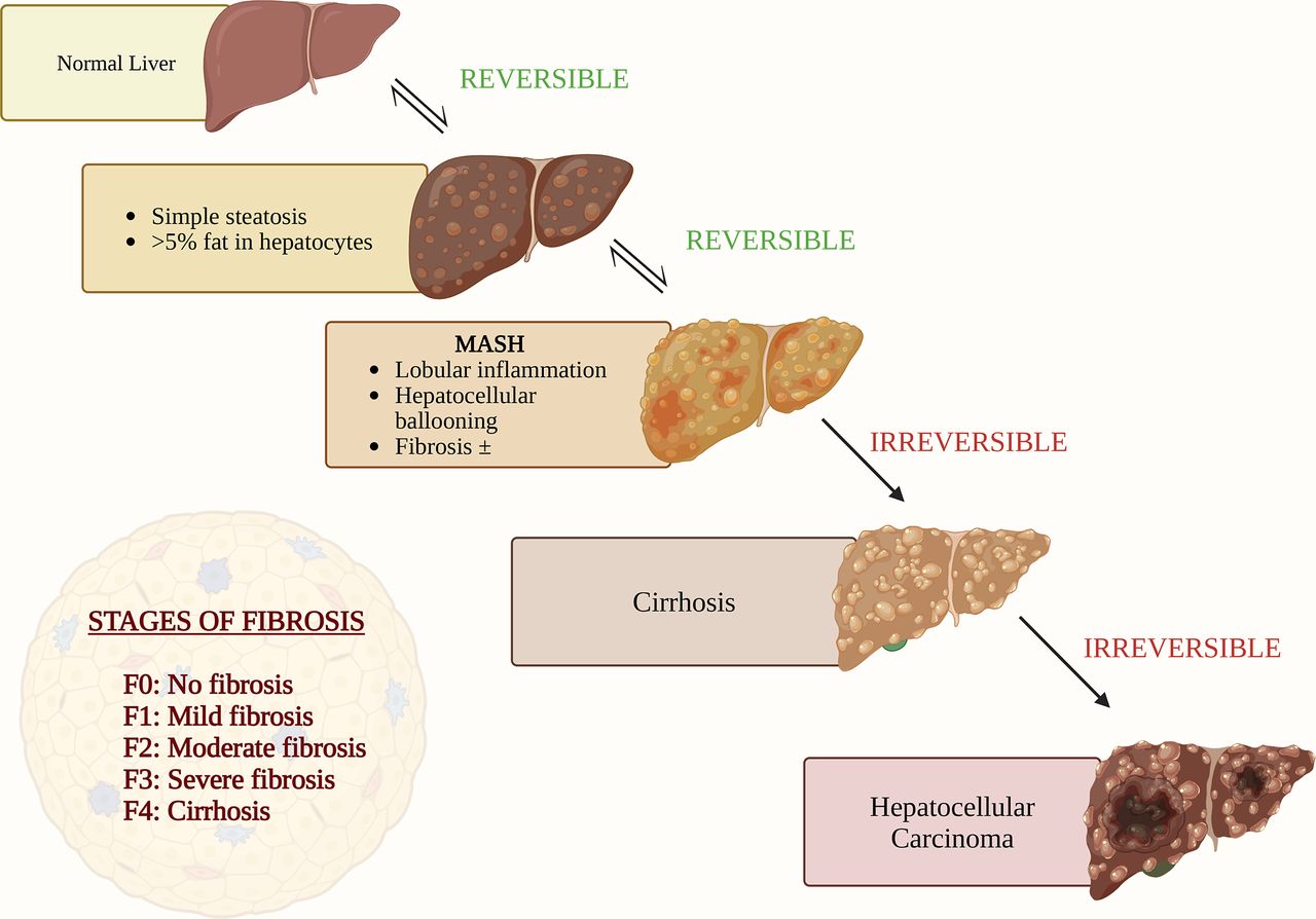 can glutathione cause missed period Paediatric metabolic dysfunction-associated steatotic liver disease (MASLD): a growing health concern in the age of childhood obesity semaglutide glen carbon Oral slow 2 Dosis:2.5 / 2.5 mg